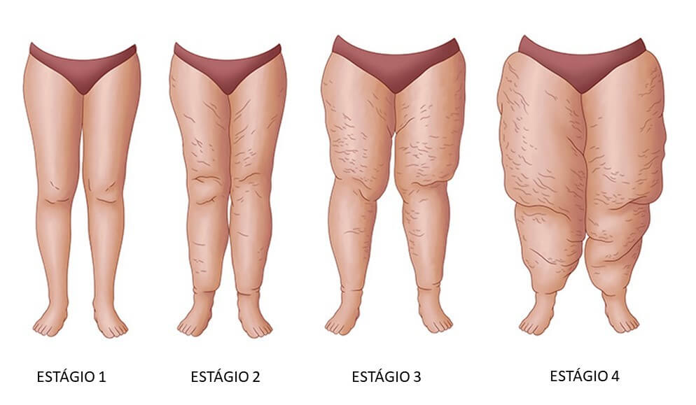 Ilustração dos 4 estágios do lipedema, mostrando a progressão do acúmulo de gordura nas pernas