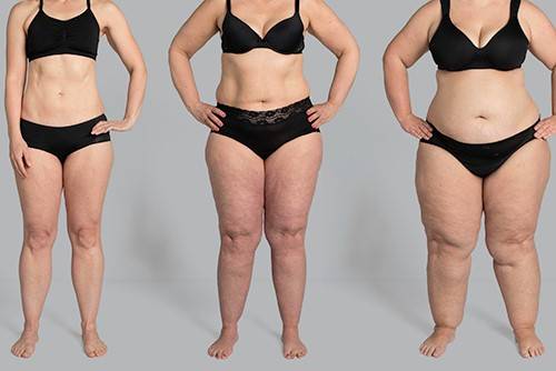 Comparativo de mulheres mostrando a desproporção típica do lipedema entre tronco e pernas